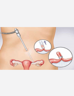 Tubal Ligation Clinic near me